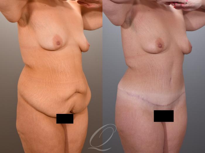 Tummy Tuck Case 1001969 Before & After Right Oblique | Serving Rochester, Syracuse & Buffalo, NY | Quatela Center for Plastic Surgery