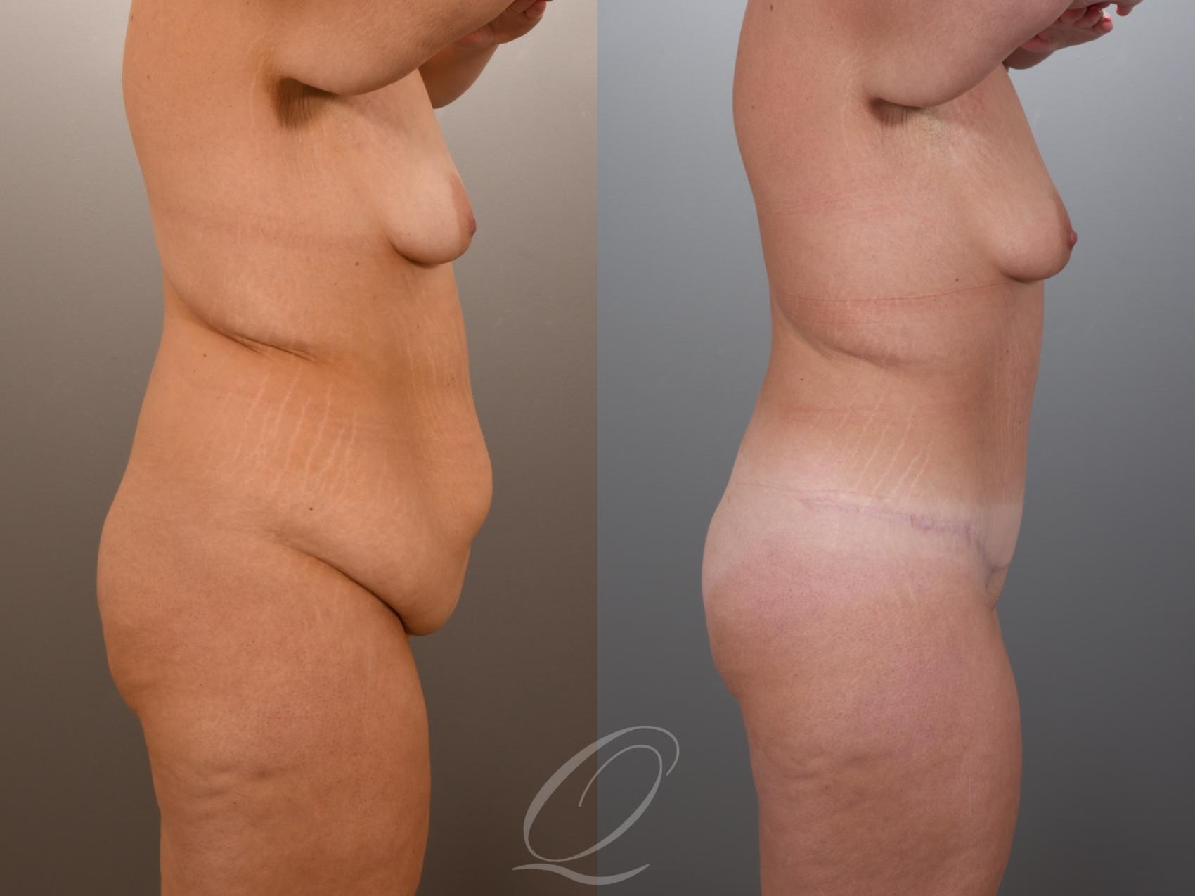 Tummy Tuck Case 1001969 Before & After Right Side | Serving Rochester, Syracuse & Buffalo, NY | Quatela Center for Plastic Surgery