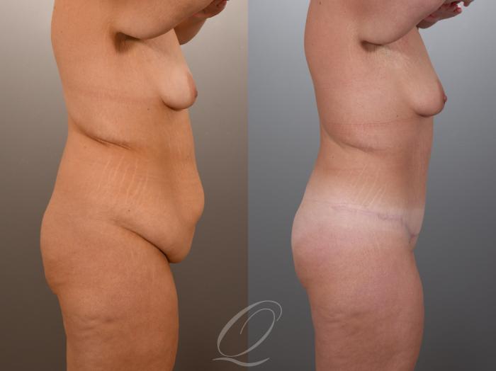 Tummy Tuck Case 1001969 Before & After Right Side | Serving Rochester, Syracuse & Buffalo, NY | Quatela Center for Plastic Surgery
