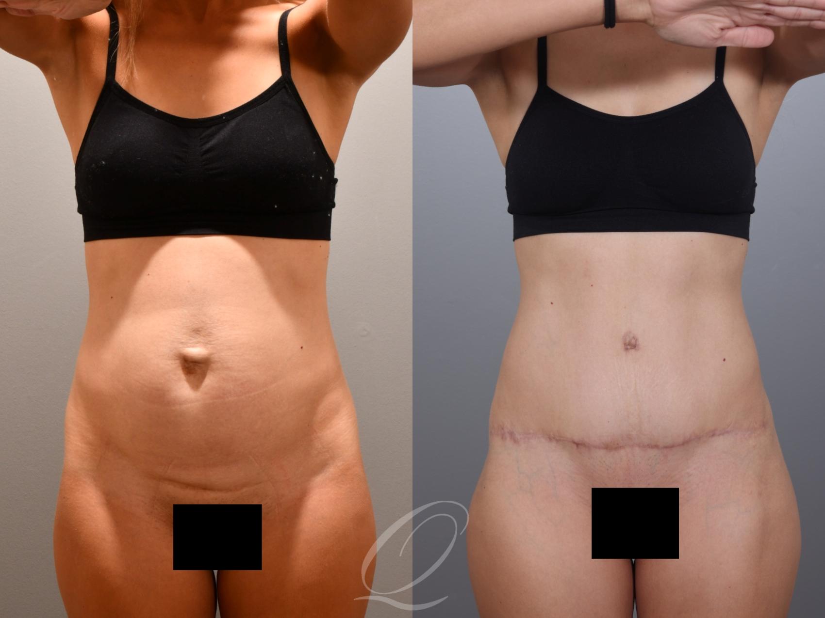 Tummy Tuck Case 1001996 Before & After Front | Serving Rochester, Syracuse & Buffalo, NY | Quatela Center for Plastic Surgery
