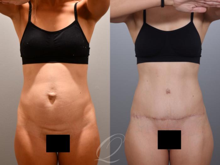 Tummy Tuck Case 1001996 Before & After Front | Serving Rochester, Syracuse & Buffalo, NY | Quatela Center for Plastic Surgery