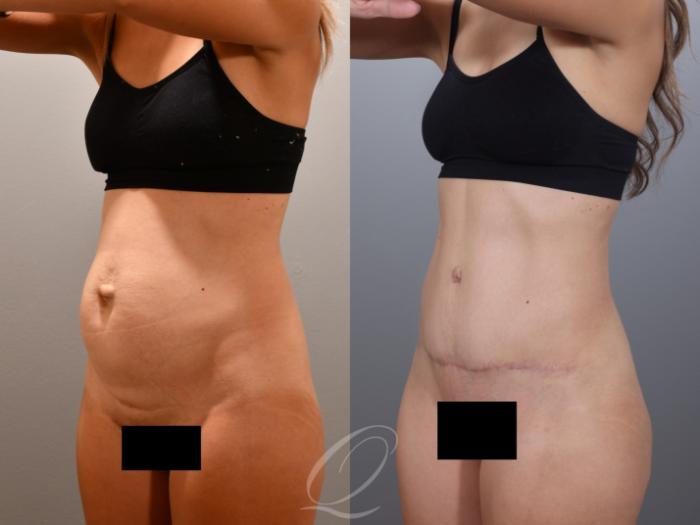 Tummy Tuck Case 1001996 Before & After Left Oblique | Serving Rochester, Syracuse & Buffalo, NY | Quatela Center for Plastic Surgery