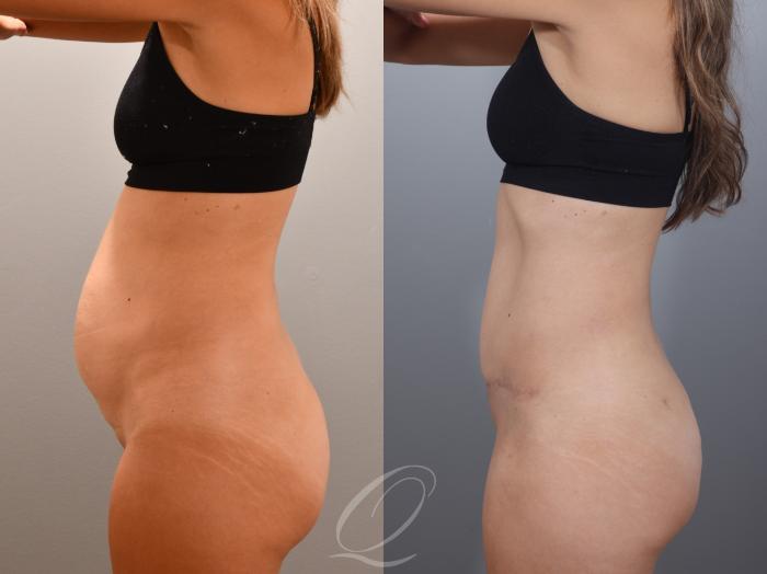 Tummy Tuck Case 1001996 Before & After Left Side | Serving Rochester, Syracuse & Buffalo, NY | Quatela Center for Plastic Surgery