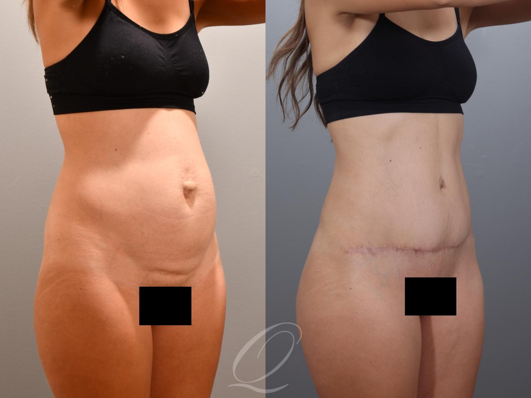 Tummy Tuck Case 1001996 Before & After Right Oblique | Serving Rochester, Syracuse & Buffalo, NY | Quatela Center for Plastic Surgery