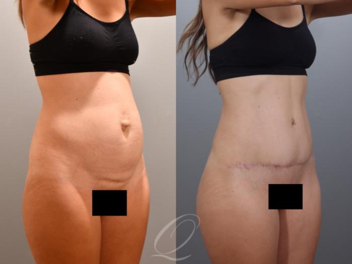 Tummy Tuck Case 1001996 Before & After Right Oblique | Serving Rochester, Syracuse & Buffalo, NY | Quatela Center for Plastic Surgery