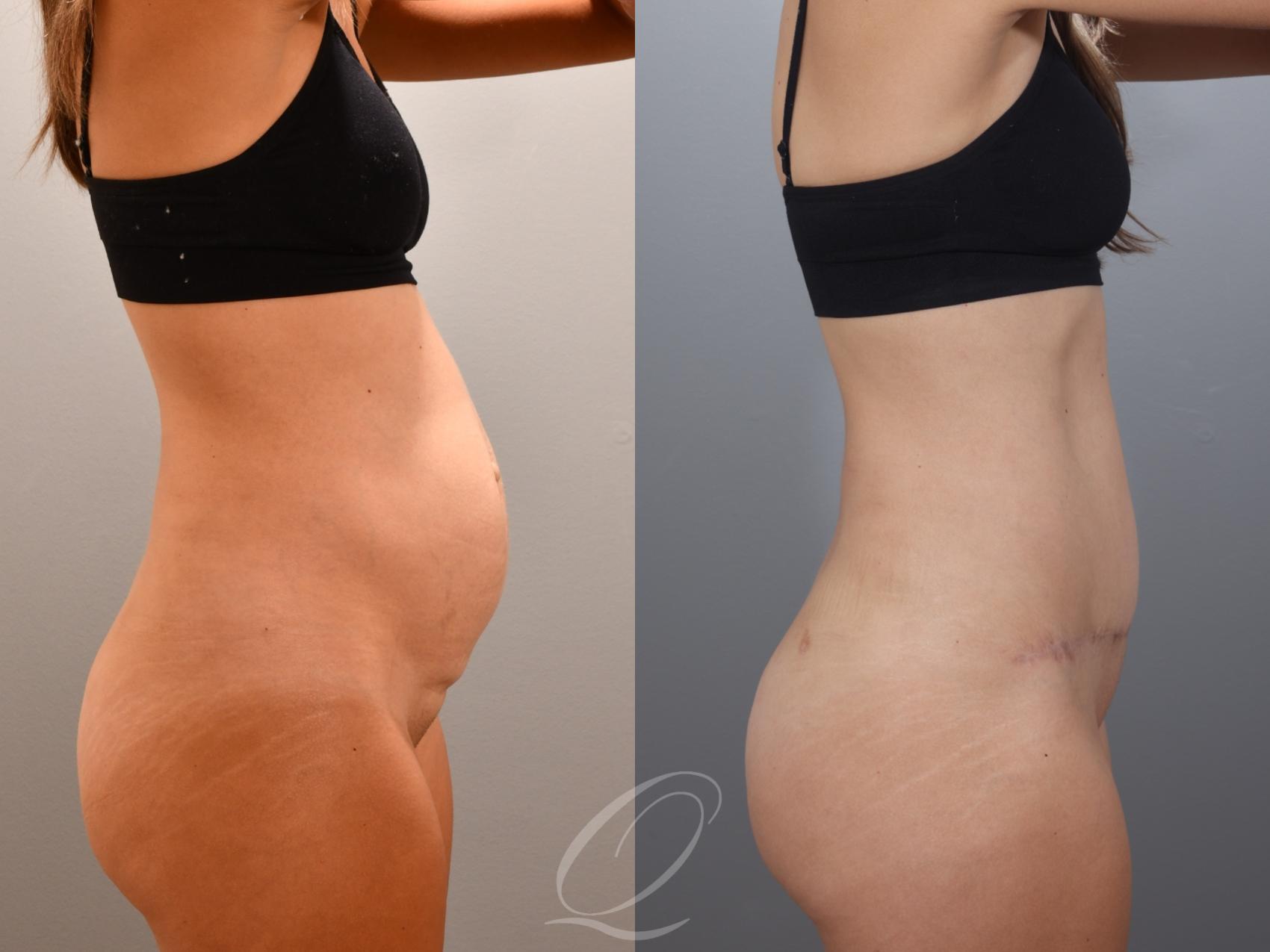 Tummy Tuck Case 1001996 Before & After Right Side | Serving Rochester, Syracuse & Buffalo, NY | Quatela Center for Plastic Surgery
