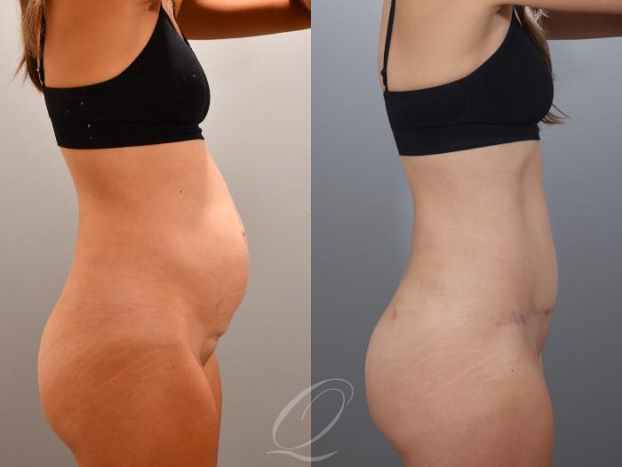 Tummy Tuck Case 1001996 Before & After Right Side | Serving Rochester, Syracuse & Buffalo, NY | Quatela Center for Plastic Surgery