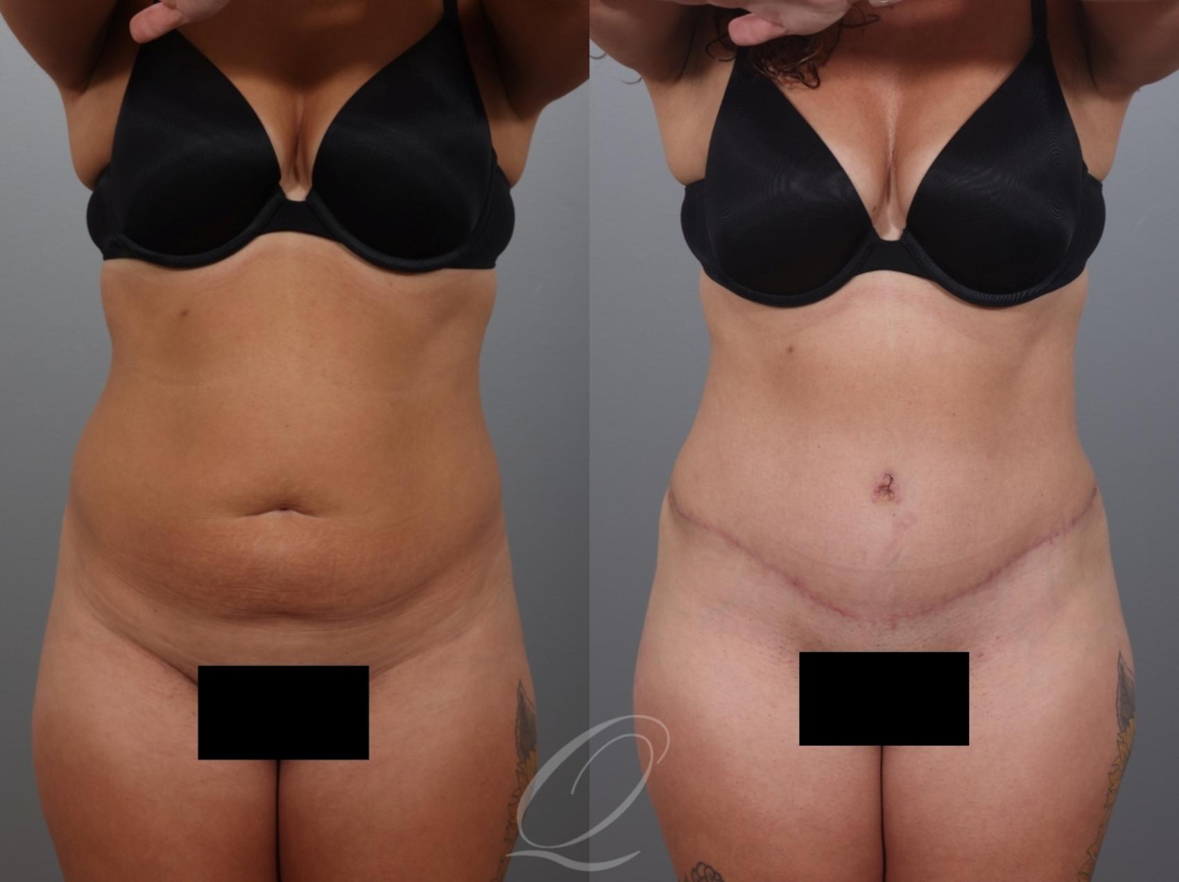 Tummy Tuck Case 1001997 Before & After Front | Serving Rochester, Syracuse & Buffalo, NY | Quatela Center for Plastic Surgery