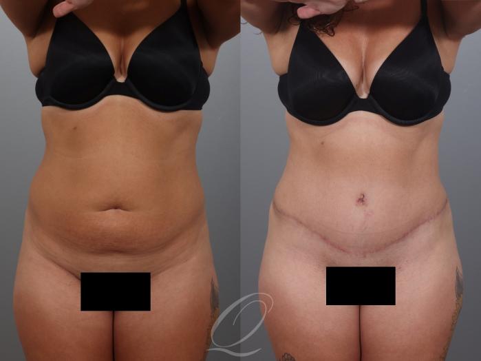 Tummy Tuck Case 1001997 Before & After Front | Serving Rochester, Syracuse & Buffalo, NY | Quatela Center for Plastic Surgery