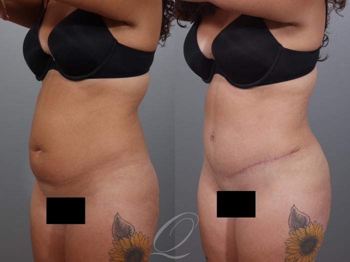 Tummy Tuck Case 1001997 Before & After Left Oblique | Serving Rochester, Syracuse & Buffalo, NY | Quatela Center for Plastic Surgery