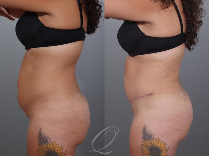 Tummy Tuck Case 1001997 Before & After Left Side | Serving Rochester, Syracuse & Buffalo, NY | Quatela Center for Plastic Surgery