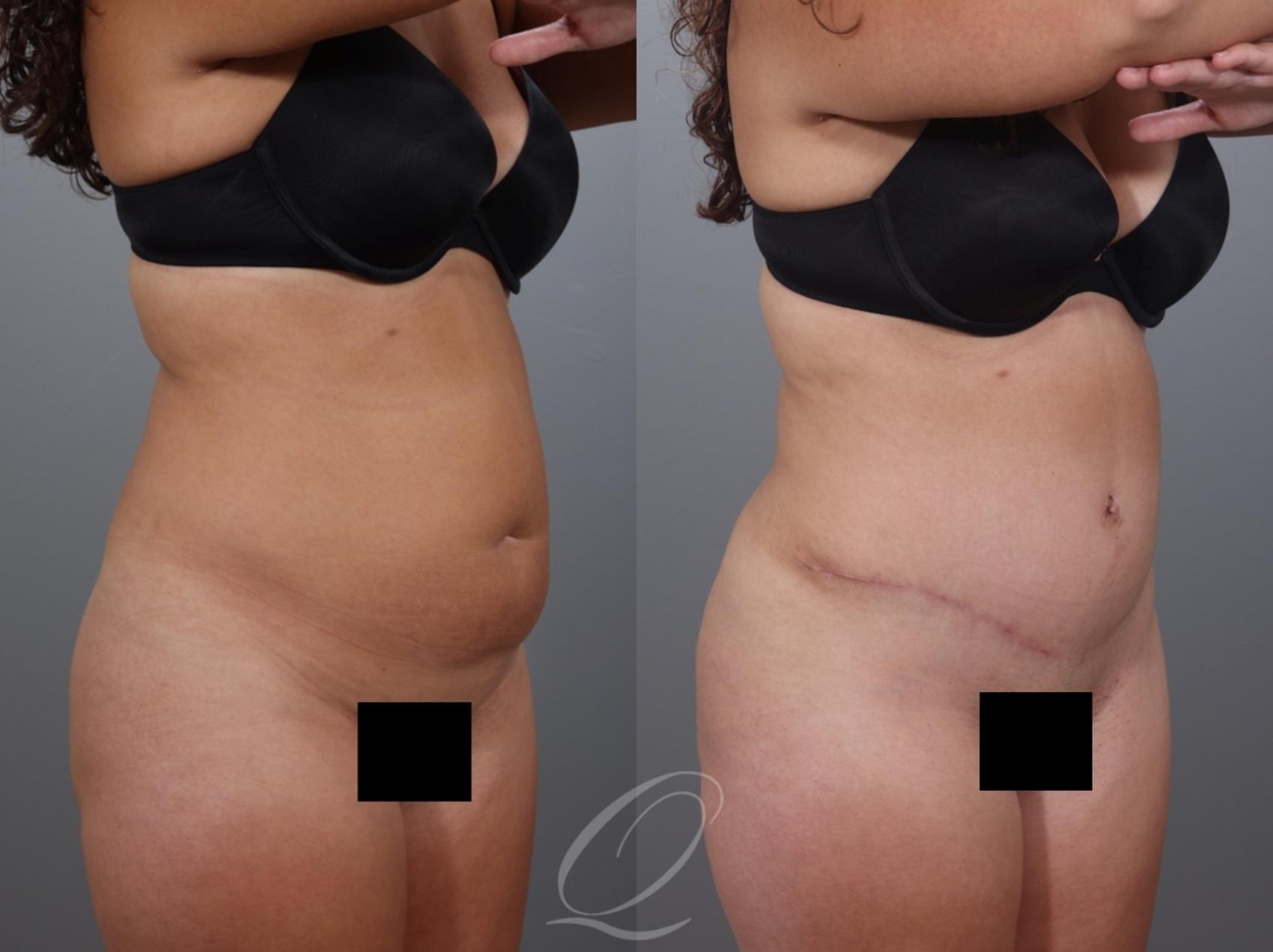 Tummy Tuck Case 1001997 Before & After Right Oblique | Serving Rochester, Syracuse & Buffalo, NY | Quatela Center for Plastic Surgery