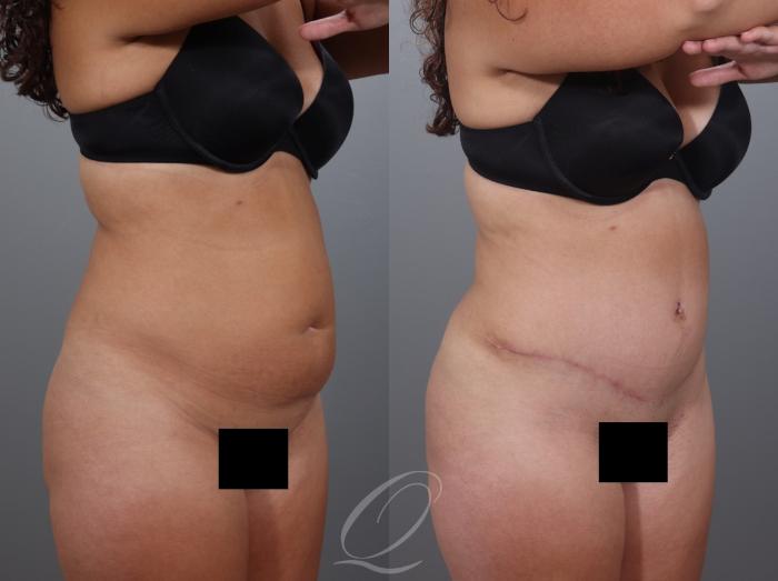 Tummy Tuck Case 1001997 Before & After Right Oblique | Serving Rochester, Syracuse & Buffalo, NY | Quatela Center for Plastic Surgery