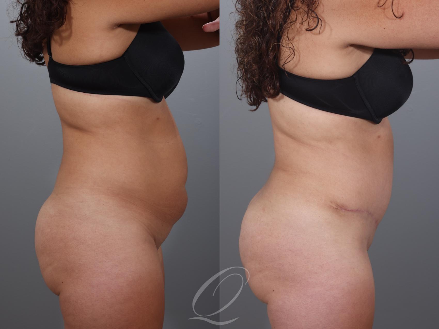 Tummy Tuck Case 1001997 Before & After Right Side | Serving Rochester, Syracuse & Buffalo, NY | Quatela Center for Plastic Surgery
