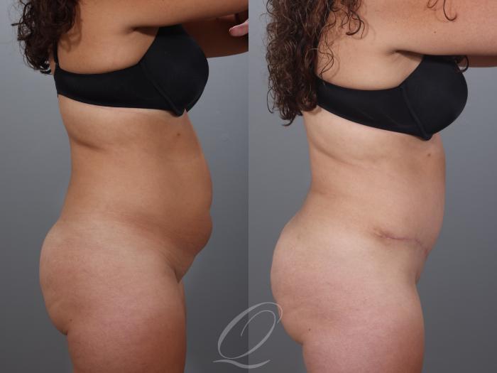 Tummy Tuck Case 1001997 Before & After Right Side | Serving Rochester, Syracuse & Buffalo, NY | Quatela Center for Plastic Surgery
