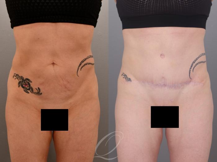 Tummy Tuck Case 1002007 Before & After Front | Serving Rochester, Syracuse & Buffalo, NY | Quatela Center for Plastic Surgery