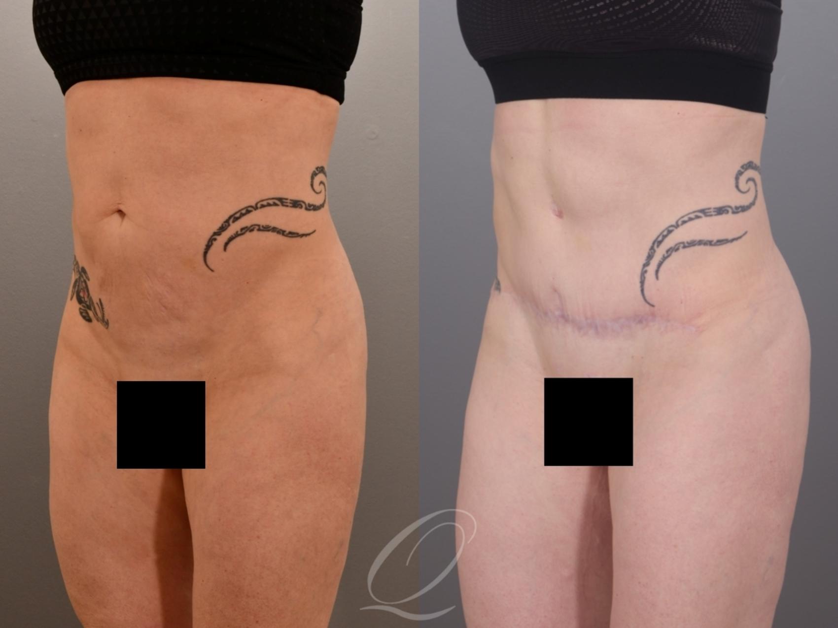Tummy Tuck Case 1002007 Before & After Left Oblique | Serving Rochester, Syracuse & Buffalo, NY | Quatela Center for Plastic Surgery