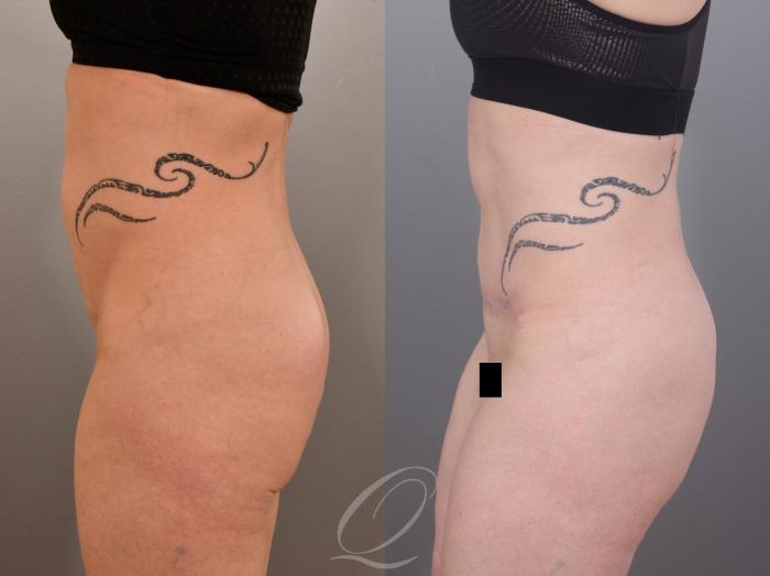 Tummy Tuck Case 1002007 Before & After Left Side | Serving Rochester, Syracuse & Buffalo, NY | Quatela Center for Plastic Surgery