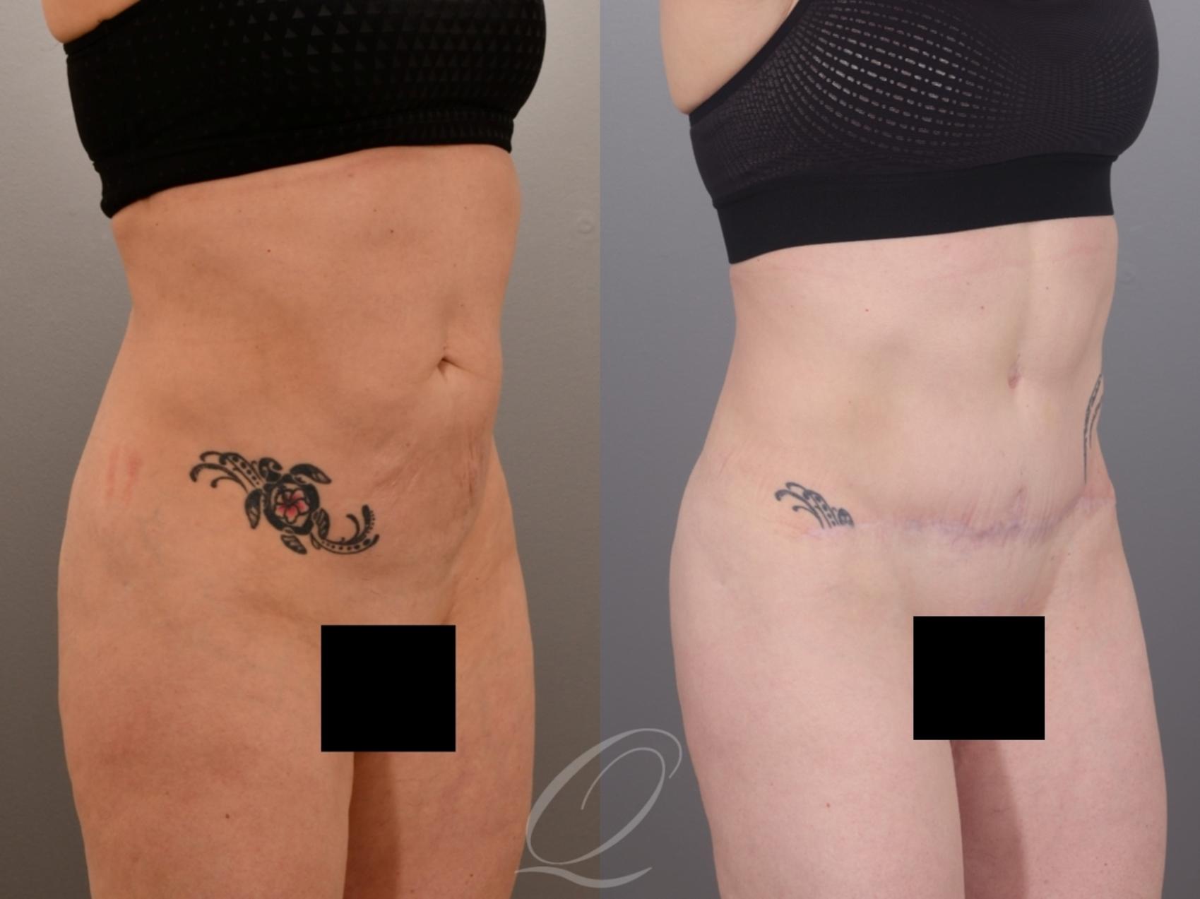 Tummy Tuck Case 1002007 Before & After Right Oblique | Serving Rochester, Syracuse & Buffalo, NY | Quatela Center for Plastic Surgery