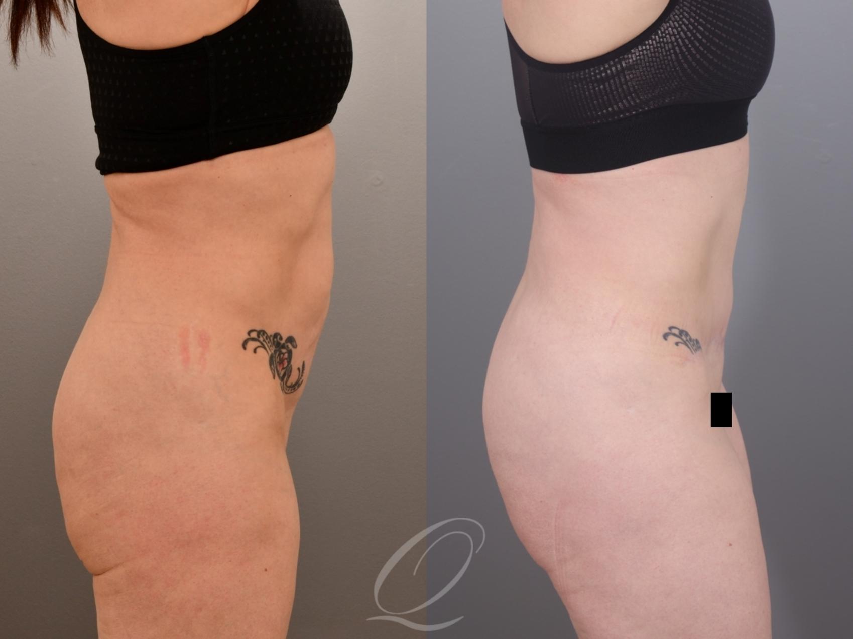 Tummy Tuck Case 1002007 Before & After Right Side | Serving Rochester, Syracuse & Buffalo, NY | Quatela Center for Plastic Surgery