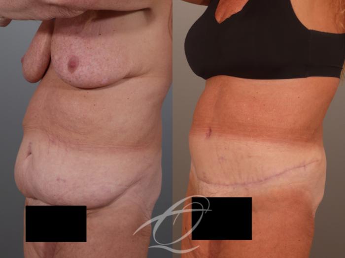 Tummy Tuck Case 1002011 Before & After Left Oblique | Serving Rochester, Syracuse & Buffalo, NY | Quatela Center for Plastic Surgery
