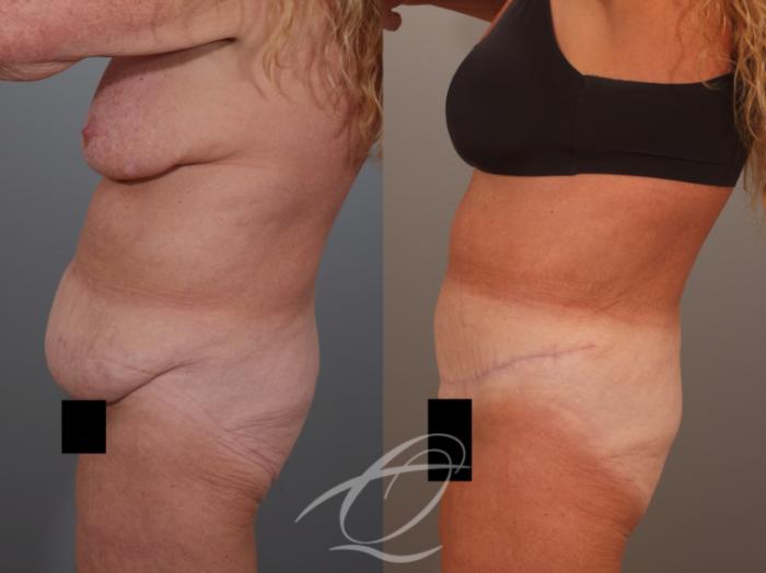 Tummy Tuck Case 1002011 Before & After Left Side | Serving Rochester, Syracuse & Buffalo, NY | Quatela Center for Plastic Surgery