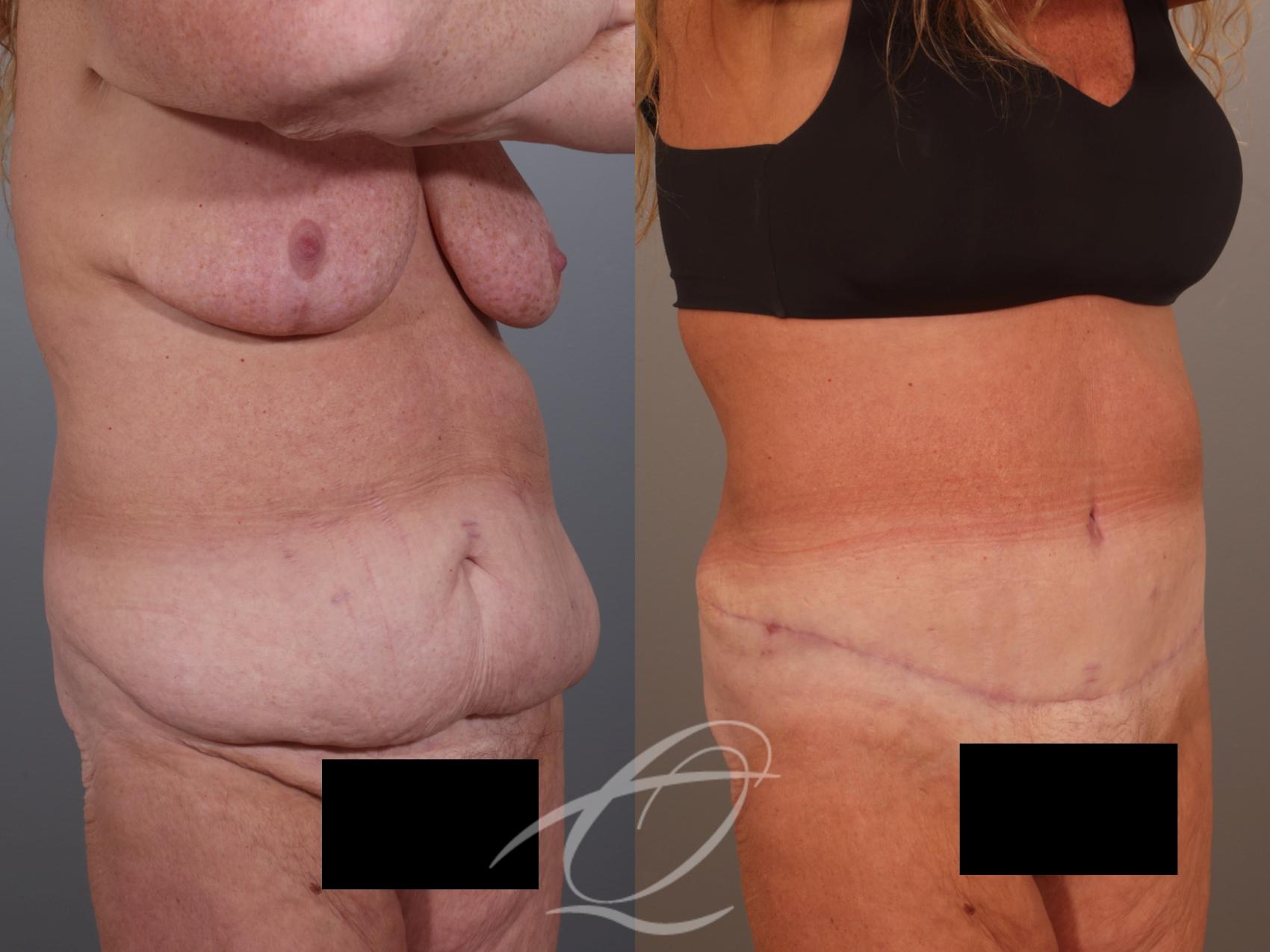 Tummy Tuck Case 1002011 Before & After Right Oblique | Serving Rochester, Syracuse & Buffalo, NY | Quatela Center for Plastic Surgery