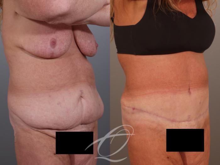 Tummy Tuck Case 1002011 Before & After Right Oblique | Serving Rochester, Syracuse & Buffalo, NY | Quatela Center for Plastic Surgery