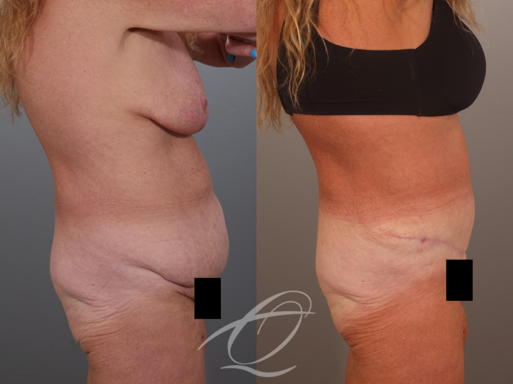 Tummy Tuck Case 1002011 Before & After Right Side | Serving Rochester, Syracuse & Buffalo, NY | Quatela Center for Plastic Surgery