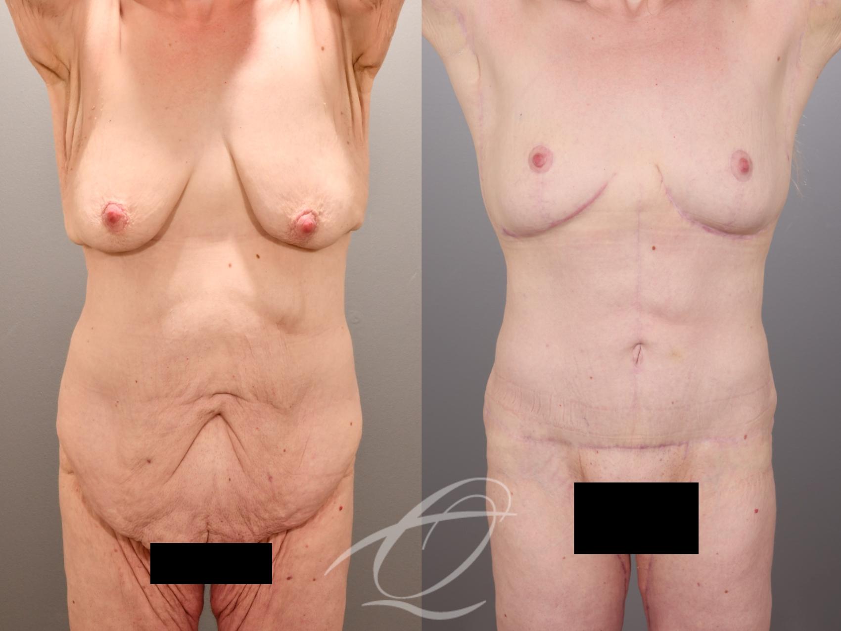 Tummy Tuck Case 1002014 Before & After Front | Serving Rochester, Syracuse & Buffalo, NY | Quatela Center for Plastic Surgery