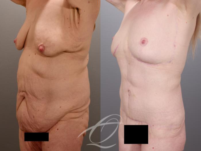 Tummy Tuck Case 1002014 Before & After Left Oblique | Serving Rochester, Syracuse & Buffalo, NY | Quatela Center for Plastic Surgery