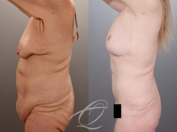 Tummy Tuck Case 1002014 Before & After Left Side | Serving Rochester, Syracuse & Buffalo, NY | Quatela Center for Plastic Surgery