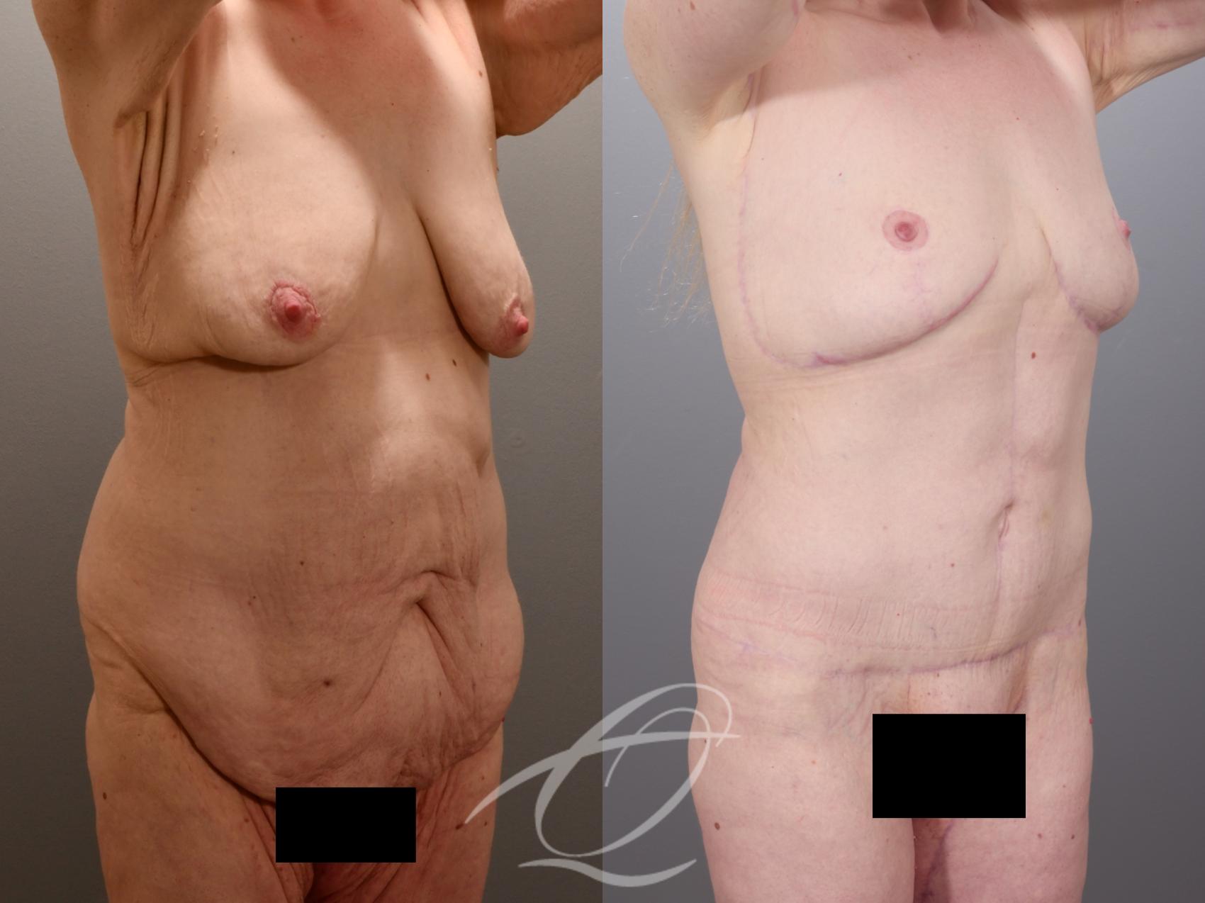 Tummy Tuck Case 1002014 Before & After Right Oblique | Serving Rochester, Syracuse & Buffalo, NY | Quatela Center for Plastic Surgery