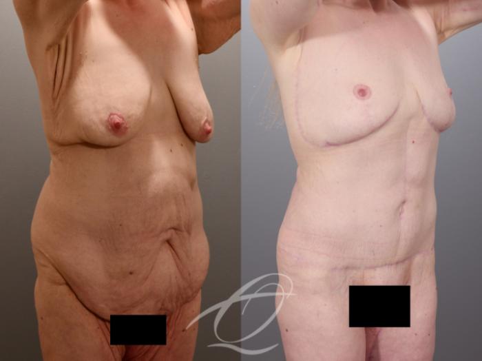 Tummy Tuck Case 1002014 Before & After Right Oblique | Serving Rochester, Syracuse & Buffalo, NY | Quatela Center for Plastic Surgery