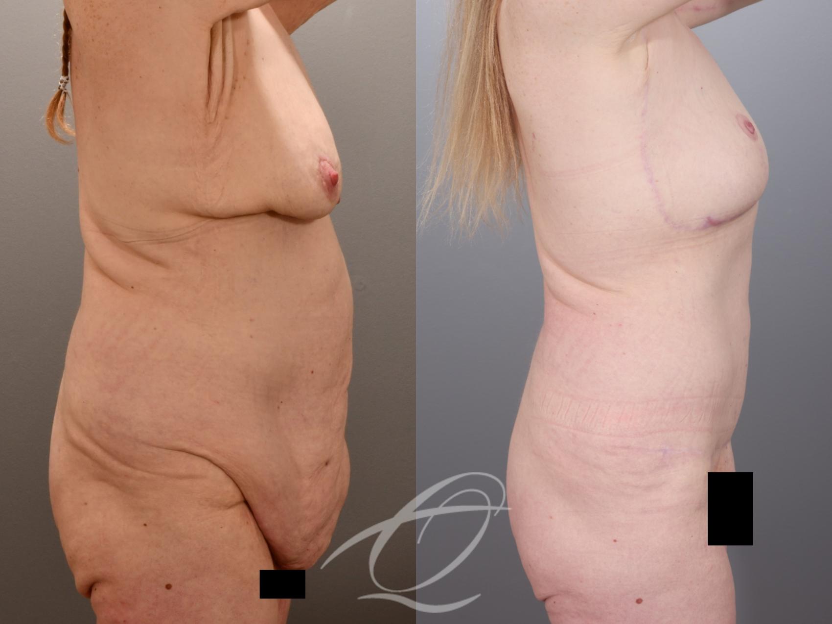 Tummy Tuck Case 1002014 Before & After Right Side | Serving Rochester, Syracuse & Buffalo, NY | Quatela Center for Plastic Surgery