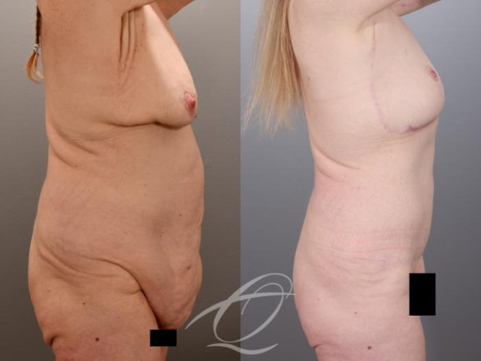 Tummy Tuck Case 1002014 Before & After Right Side | Serving Rochester, Syracuse & Buffalo, NY | Quatela Center for Plastic Surgery