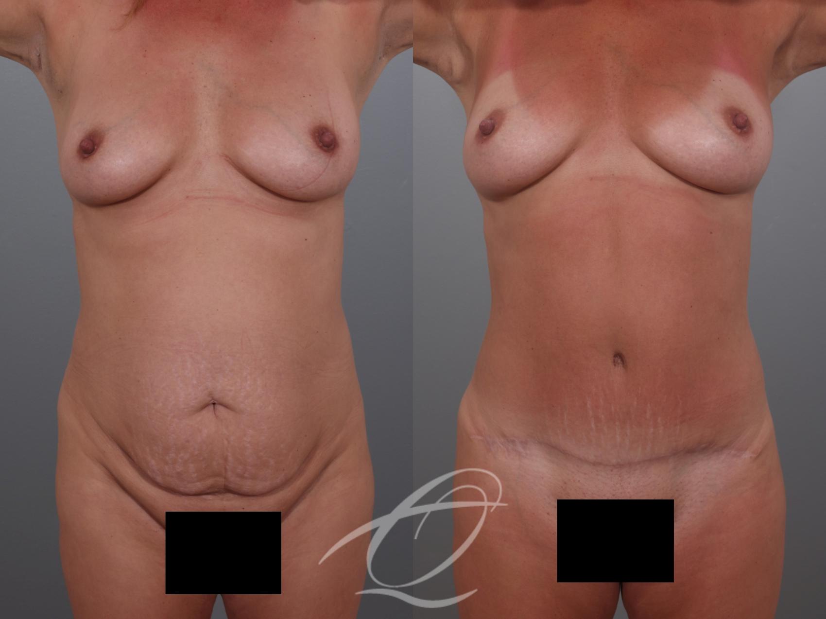 Tummy Tuck Case 1002029 Before & After Front | Serving Rochester, Syracuse & Buffalo, NY | Quatela Center for Plastic Surgery