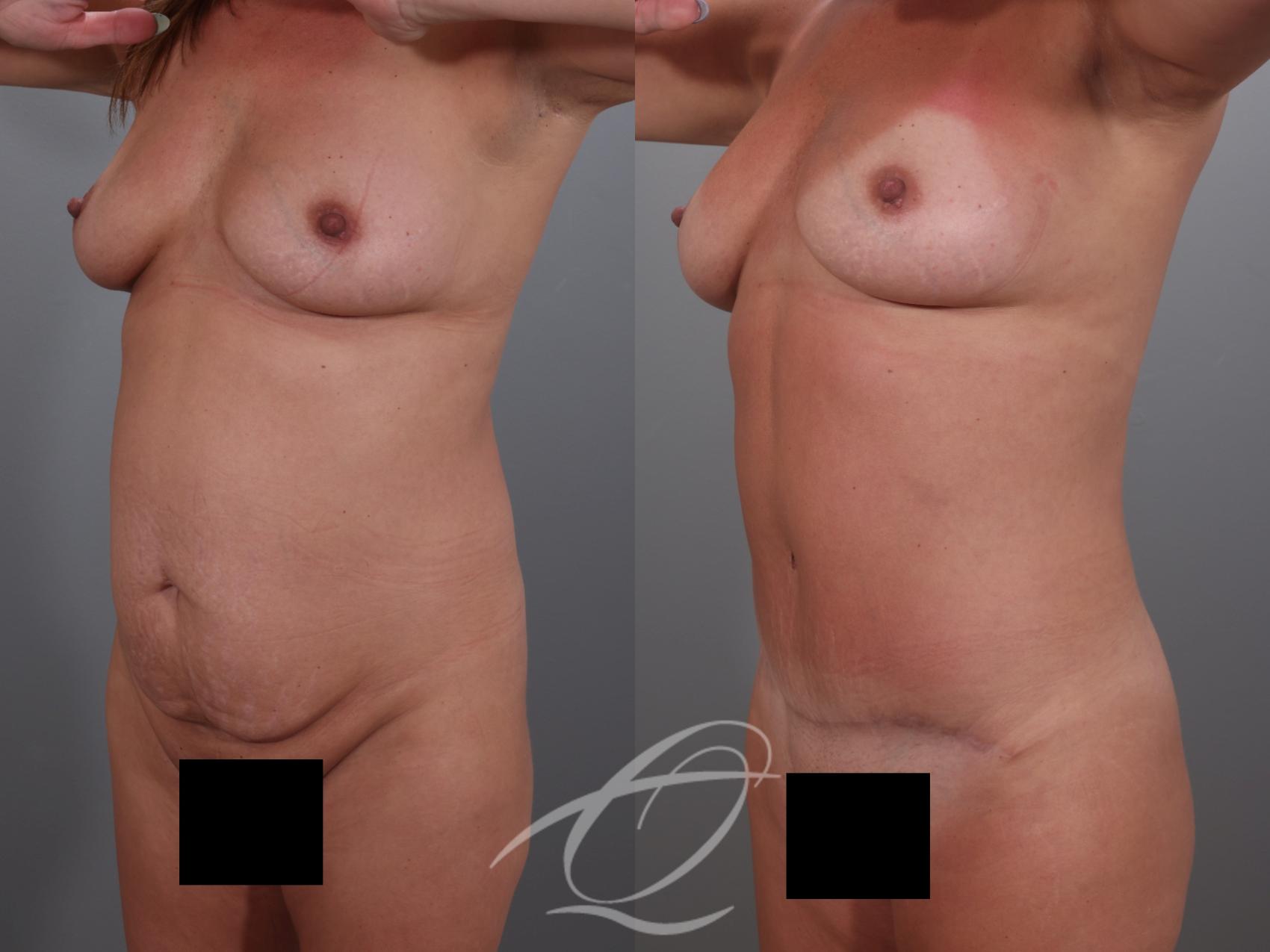 Tummy Tuck Case 1002029 Before & After Left Oblique | Serving Rochester, Syracuse & Buffalo, NY | Quatela Center for Plastic Surgery