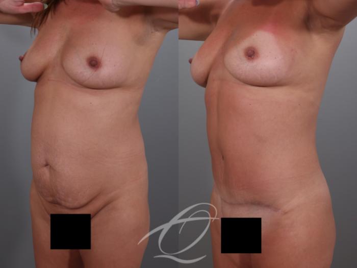 Tummy Tuck Case 1002029 Before & After Left Oblique | Serving Rochester, Syracuse & Buffalo, NY | Quatela Center for Plastic Surgery