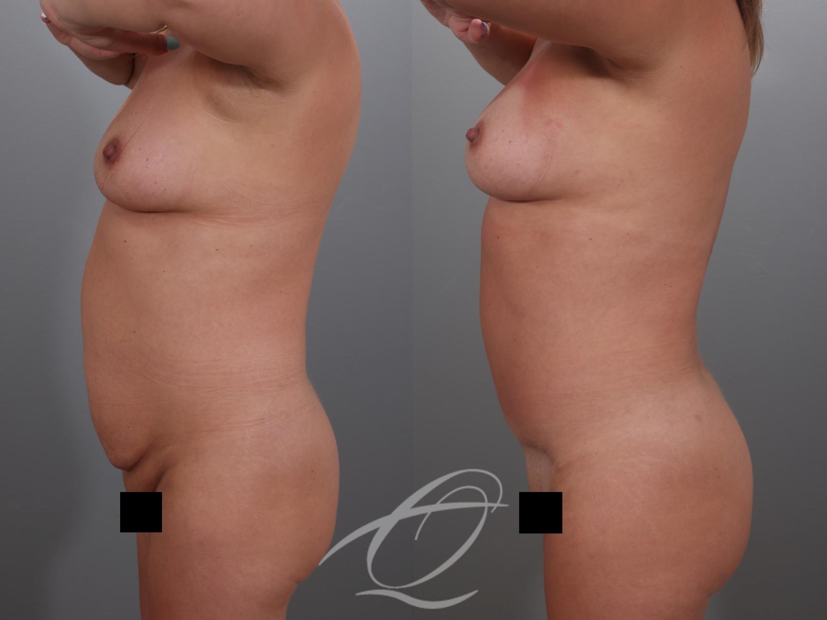 Tummy Tuck Case 1002029 Before & After Left Side | Serving Rochester, Syracuse & Buffalo, NY | Quatela Center for Plastic Surgery
