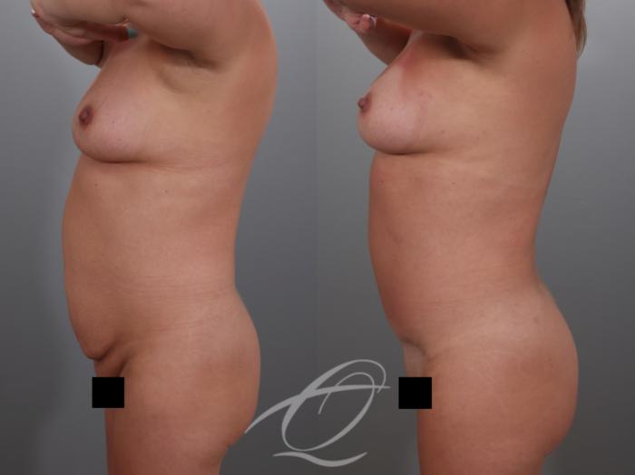 Tummy Tuck Case 1002029 Before & After Left Side | Serving Rochester, Syracuse & Buffalo, NY | Quatela Center for Plastic Surgery