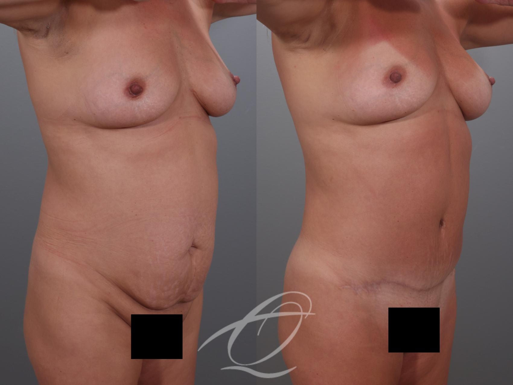 Tummy Tuck Case 1002029 Before & After Right Oblique | Serving Rochester, Syracuse & Buffalo, NY | Quatela Center for Plastic Surgery