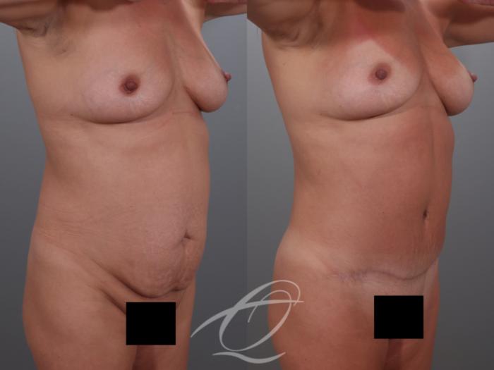 Tummy Tuck Case 1002029 Before & After Right Oblique | Serving Rochester, Syracuse & Buffalo, NY | Quatela Center for Plastic Surgery