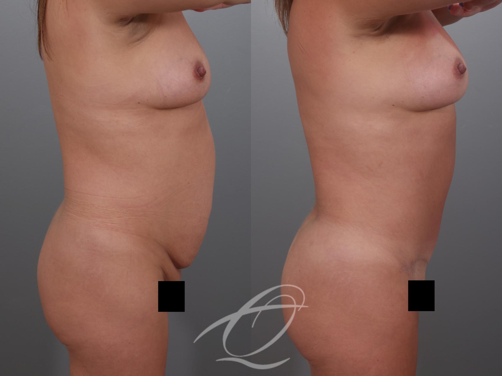 Tummy Tuck Case 1002029 Before & After Right Side | Serving Rochester, Syracuse & Buffalo, NY | Quatela Center for Plastic Surgery