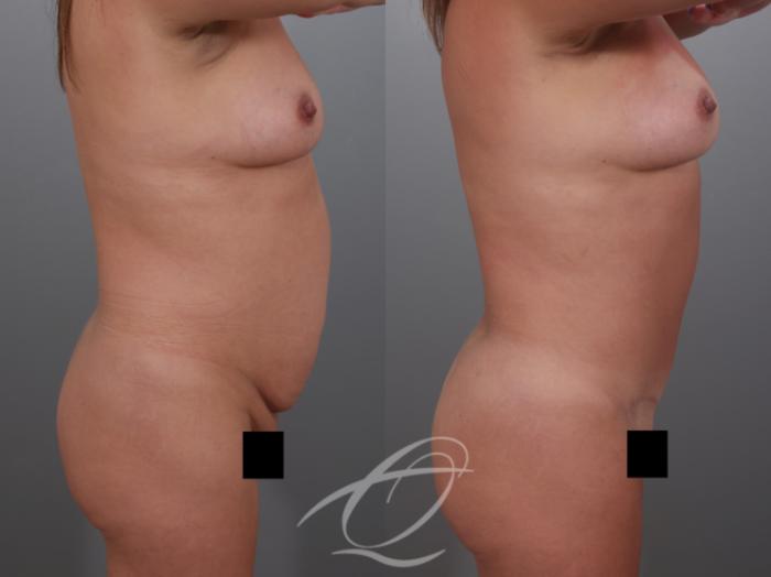 Tummy Tuck Case 1002029 Before & After Right Side | Serving Rochester, Syracuse & Buffalo, NY | Quatela Center for Plastic Surgery