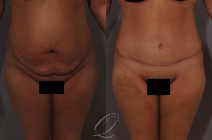 Tummy Tuck Case 1061 Before & After View #1 | Serving Rochester, Syracuse & Buffalo, NY | Quatela Center for Plastic Surgery