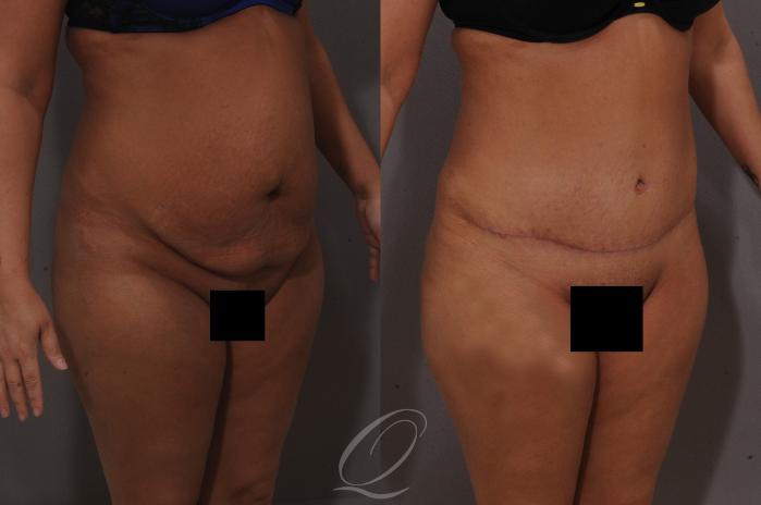 Tummy Tuck Case 1061 Before & After View #2 | Serving Rochester, Syracuse & Buffalo, NY | Quatela Center for Plastic Surgery