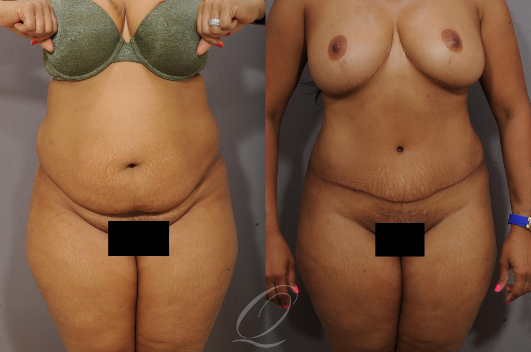 Tummy Tuck Case 1062 Before & After View #1 | Serving Rochester, Syracuse & Buffalo, NY | Quatela Center for Plastic Surgery