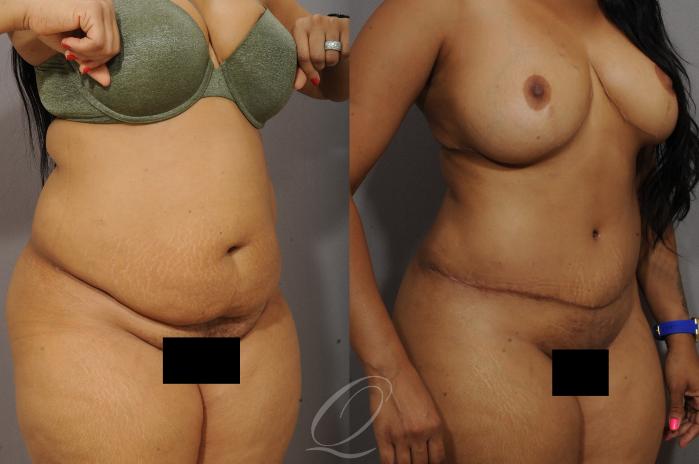 Tummy Tuck Case 1062 Before & After View #2 | Serving Rochester, Syracuse & Buffalo, NY | Quatela Center for Plastic Surgery