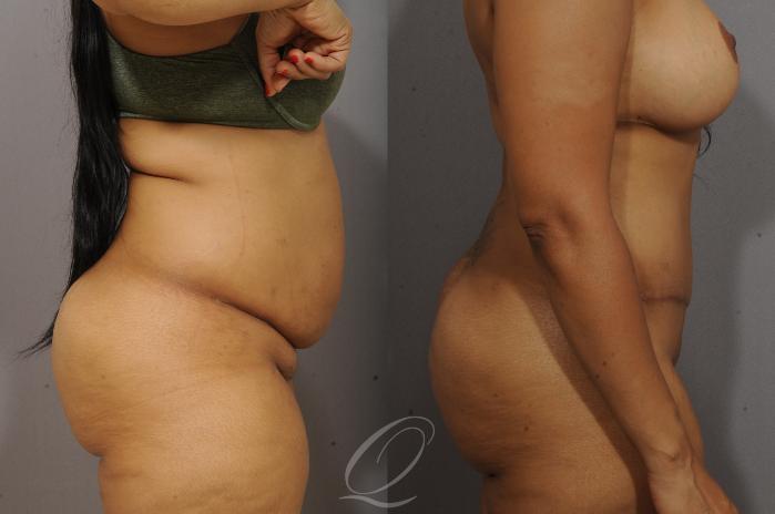 Tummy Tuck Case 1062 Before & After View #3 | Serving Rochester, Syracuse & Buffalo, NY | Quatela Center for Plastic Surgery